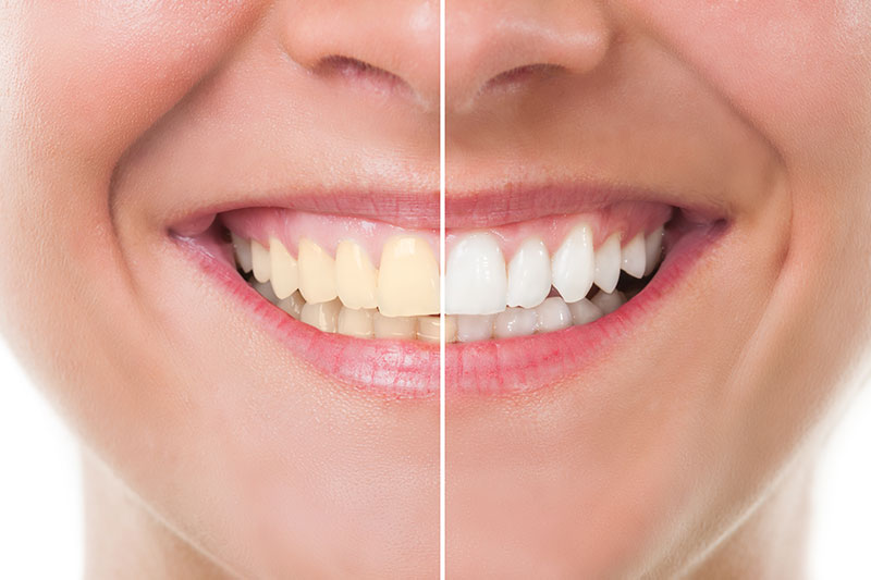 Teeth Whitening - Westchester Dental Office, Los Angeles Dentist